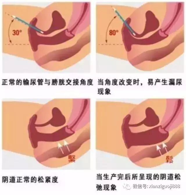 產後鬆弛 私密處微整形緊緻醫美怎麼選 璞美整形外科
