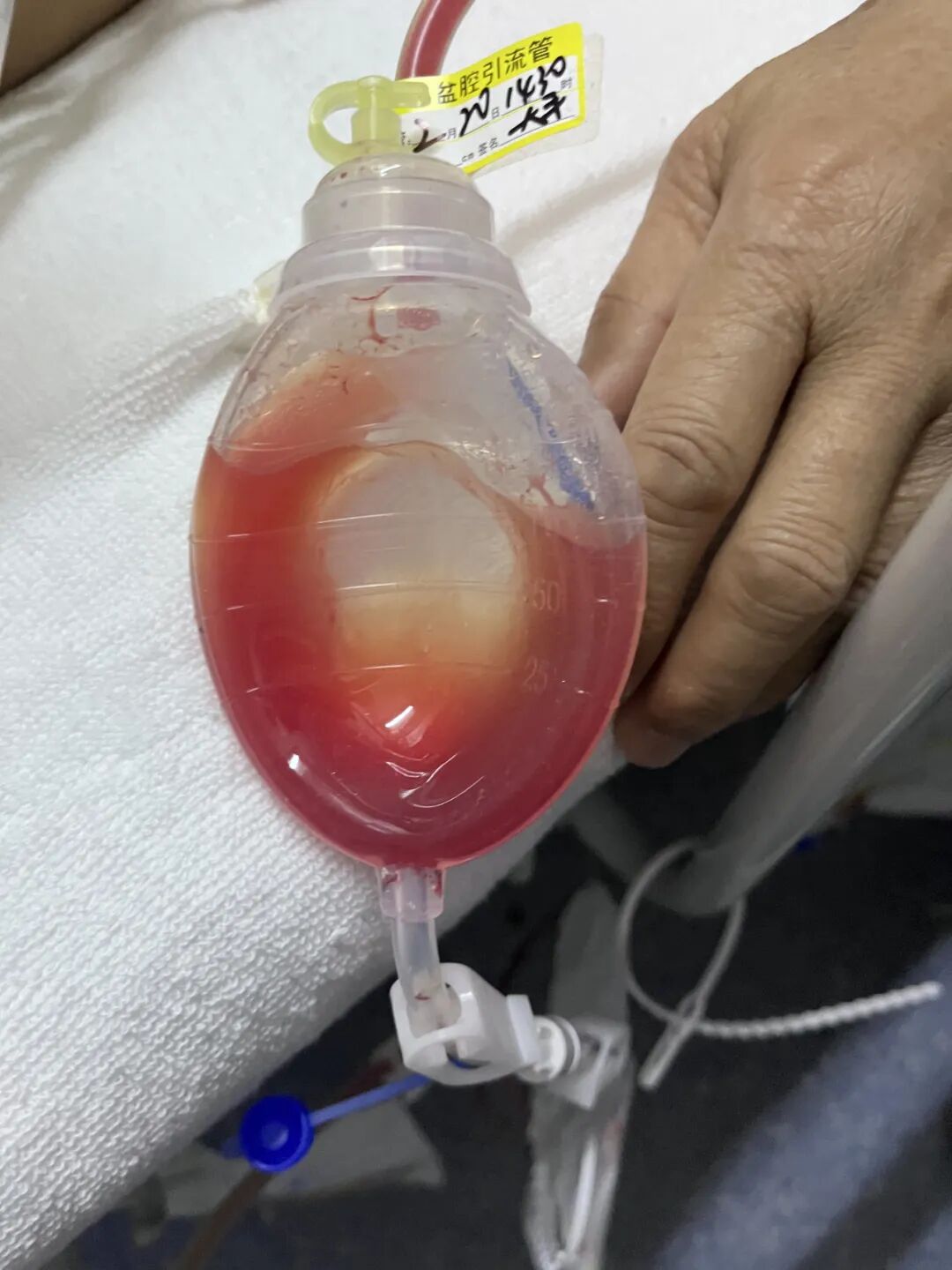 引流管怎么标识常见各类管道护理规范（评估、标识及固定）_https://www.jmylbn.com_新闻资讯_第6张