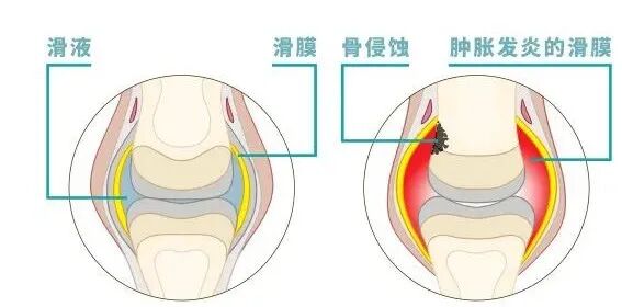 滑膜炎症状及治疗