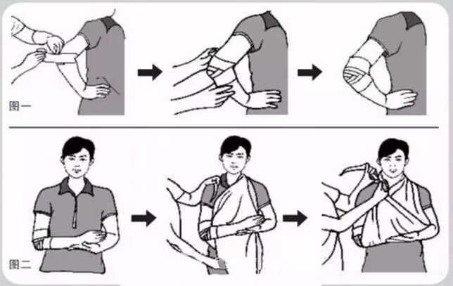 在上肢受伤时人字形包扎法更适用于,肘部,膝部,足跟部等关节处伤口的