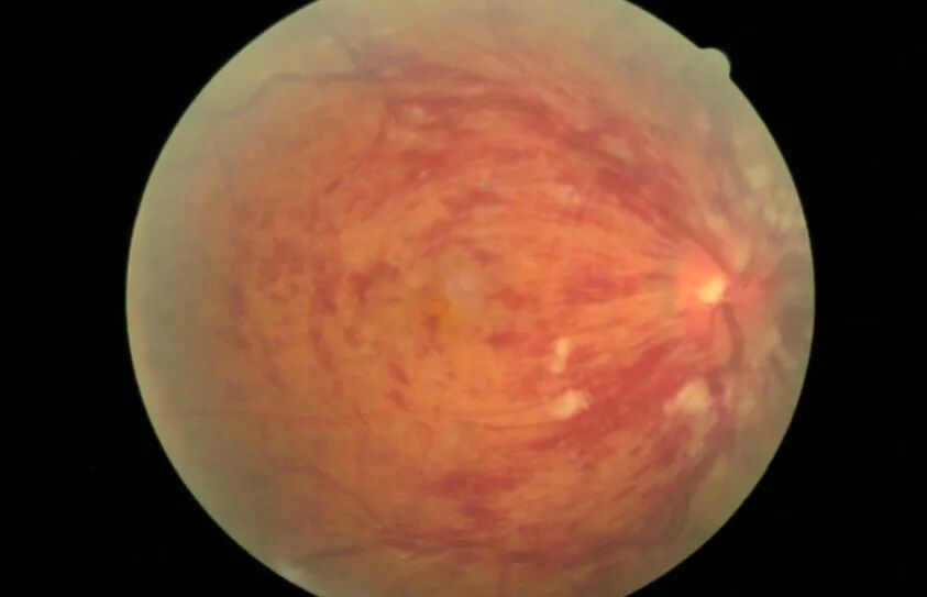 眼科ab超检查单怎么看常见眼底疾病检查结果的秒懂解读_https://www.jmylbn.com_新闻资讯_第11张