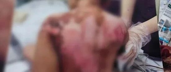 6岁被虐女童医生发声：其母曾因医疗费贵拒绝治疗，将孩子带离医院