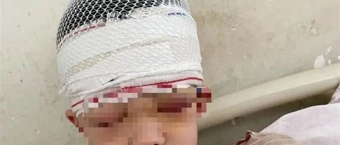 上课时“讲小话”9岁男孩被老师体罚致头皮头骨分离