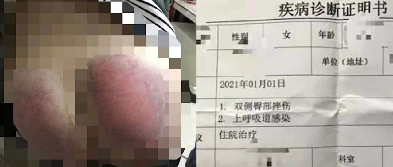 女童因未完成作业被老师殴打住院，老师：她不哭不躲，我以为板子不痛