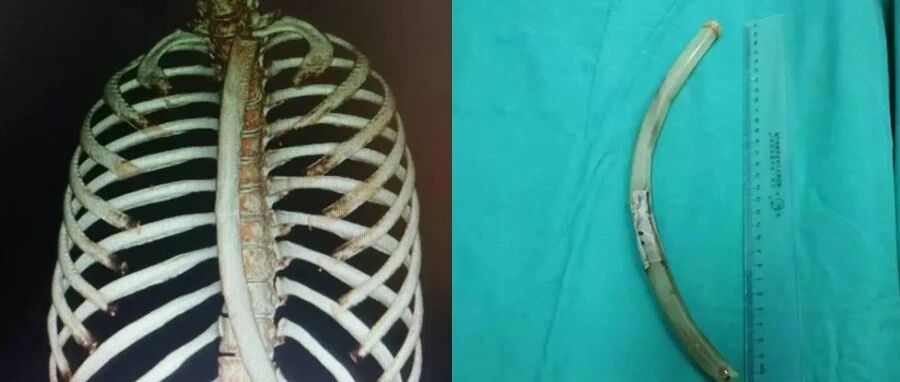 女子减肥催吐将塑料管插入胃里，到底是仙女管还是夺命管！