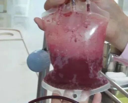 什么是臭氧大自血疗法【专家共识】三氧大自血疗法--血液好身体就好！_https://www.jmylbn.com_新闻资讯_第2张