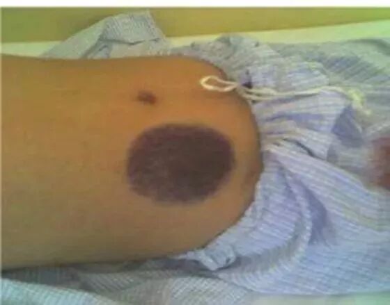 打肝素怎么拔针低分子肝素钙的注射方法&注意事项     收了！_https://www.jmylbn.com_新闻资讯_第8张