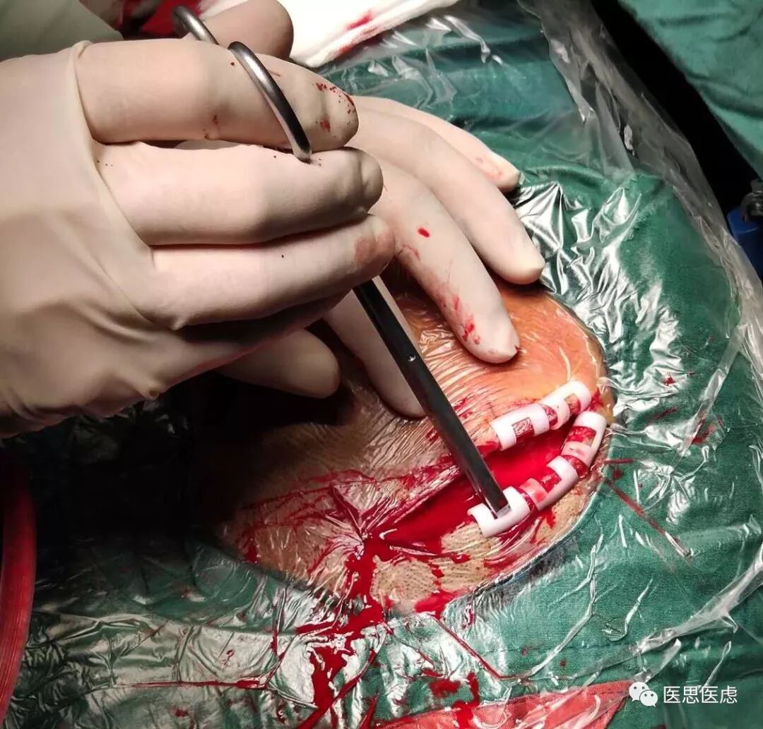 手术头皮夹怎么放神外有趣的小物件---头皮夹_https://www.jmylbn.com_新闻资讯_第5张