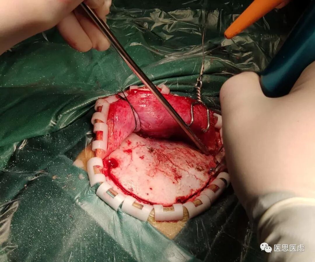 手术头皮夹怎么放神外有趣的小物件---头皮夹_https://www.jmylbn.com_新闻资讯_第6张