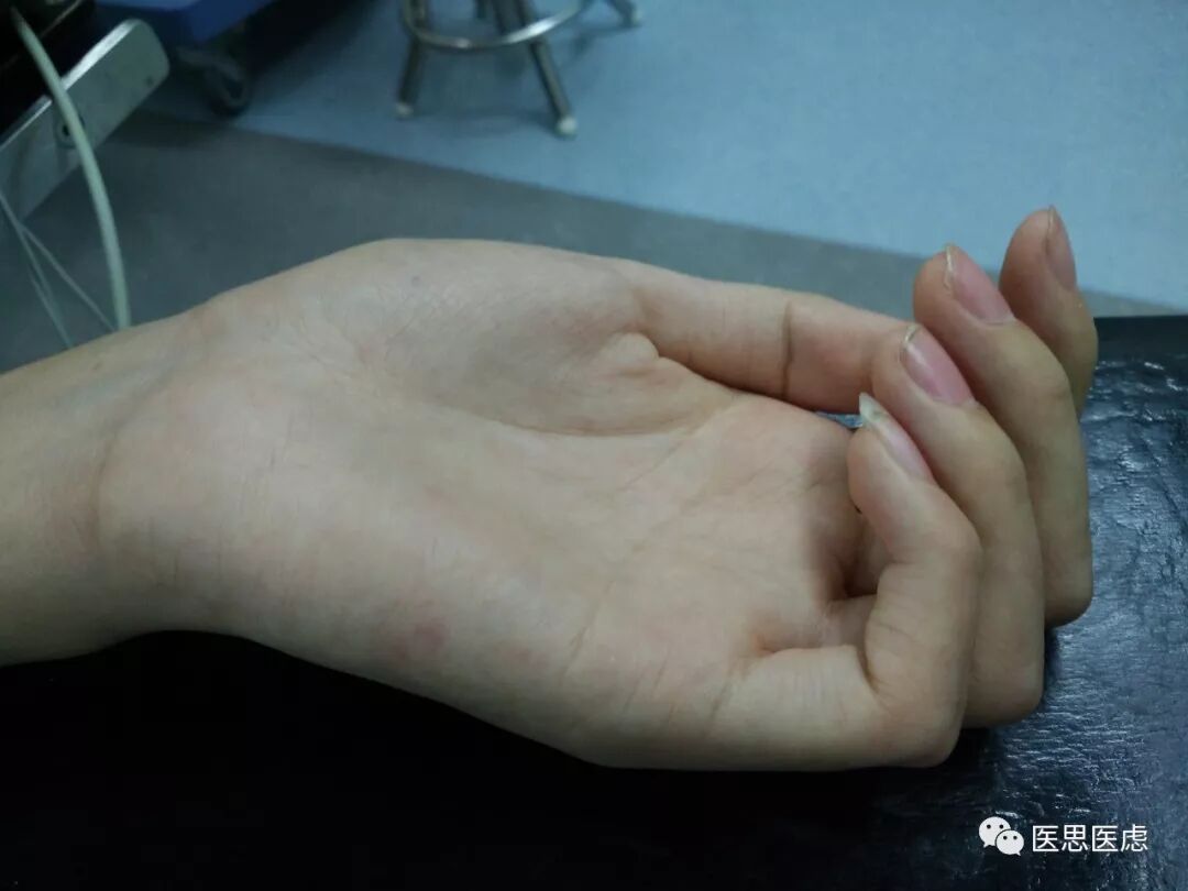 瘦瘦高高 指头长长 警惕马凡氏综合征 医思医虑 微信公众号文章阅读 Wemp