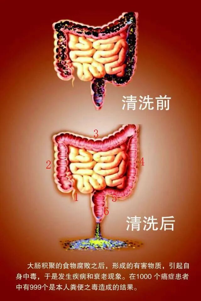 结肠水疗仪怎么用【结肠透析治疗机】便秘患者的福音——给肠道“洗个澡”_https://www.jmylbn.com_新闻资讯_第9张