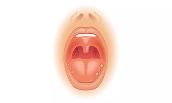 口腔溃疡怪“上火”？5招搞定它