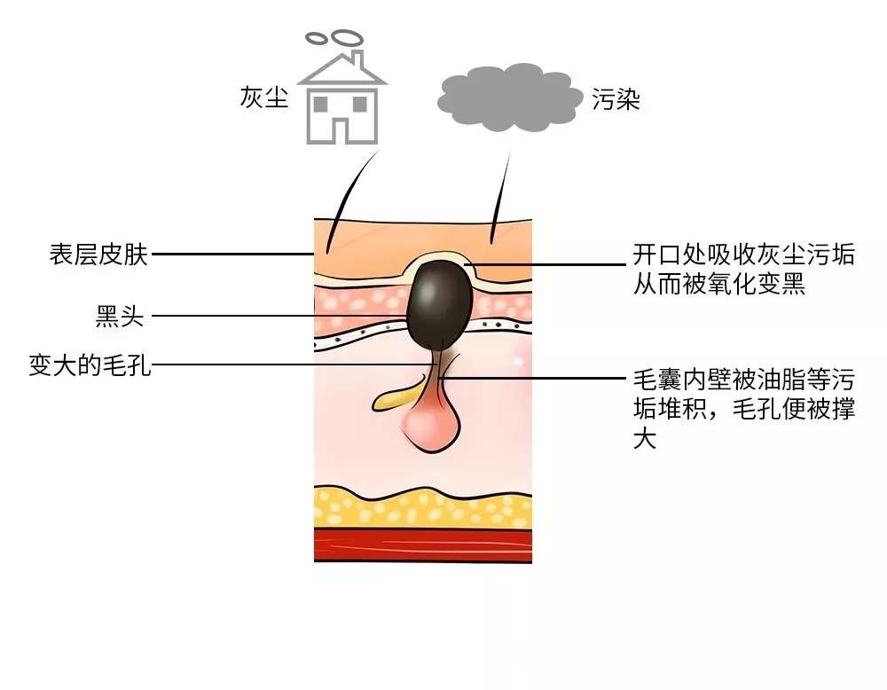 终极黑头清理攻略,草莓鼻必看! 终极黑头清理攻略,草莓鼻必看!