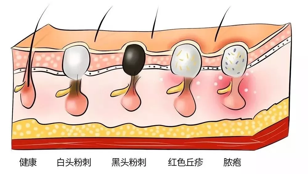 终极黑头清理攻略,草莓鼻必看! 终极黑头清理攻略,草莓鼻必看!