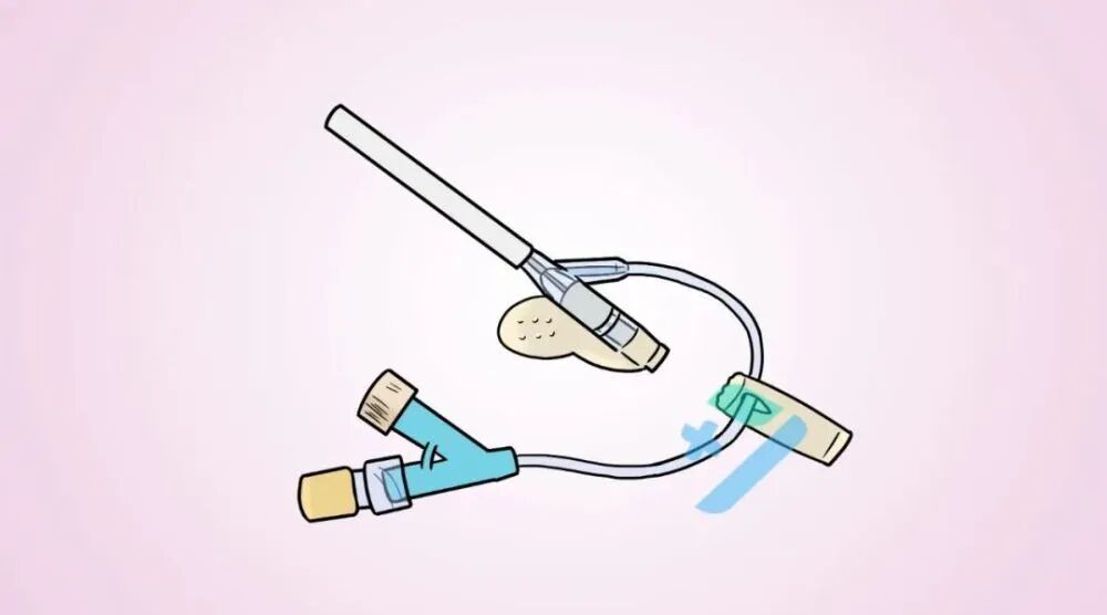 为什么输血不能用小针手术室里的留置针，“针”有讲究！_https://www.jmylbn.com_新闻资讯_第5张