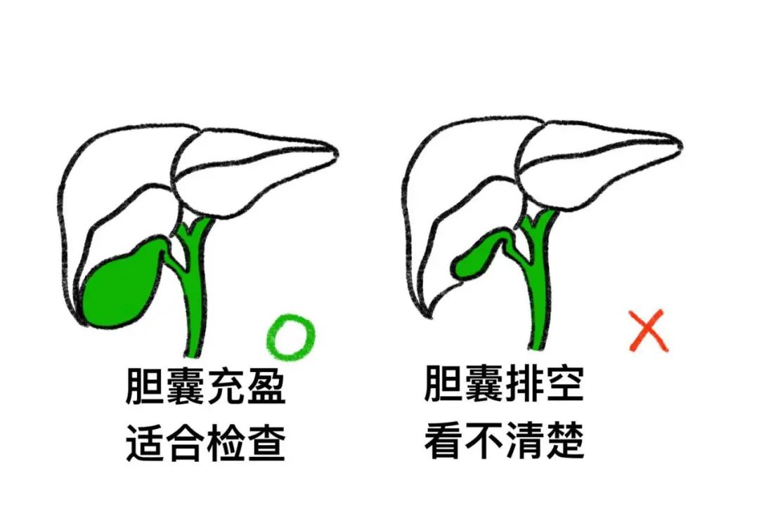 空腹|【科普】体检要空腹，怎样才算 “空”？