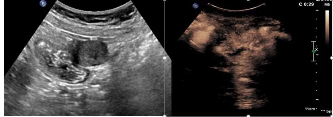 胃造影用的是什么机子超声丨如果你实在害怕胃镜，可以试试胃部彩超检查_https://www.jmylbn.com_新闻资讯_第4张