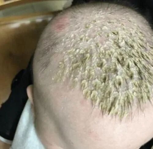 那么婴儿头皮上的"黄皮"究竟