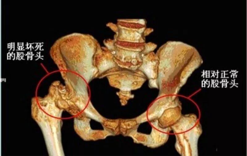王氏冷敷贴:股骨头坏死的病因与保守治疗