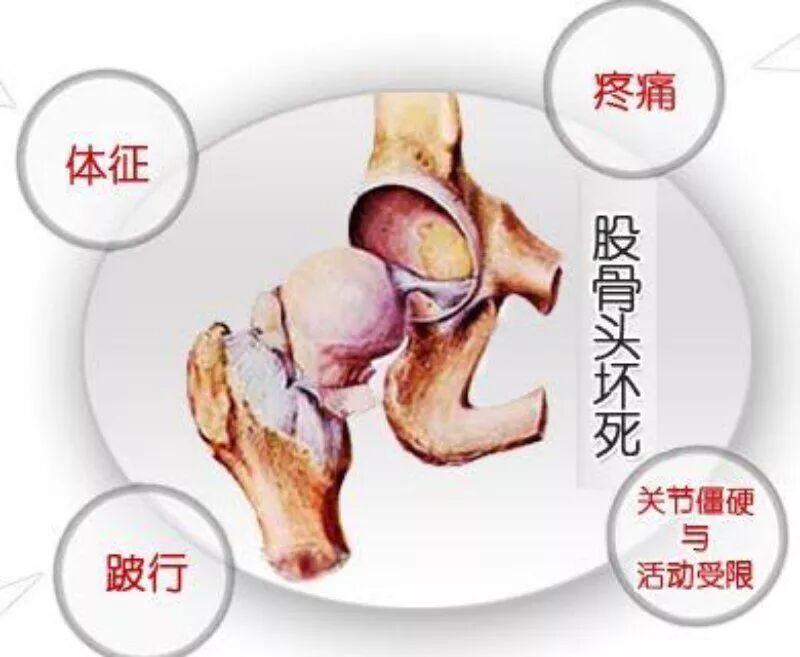 王氏冷敷贴:股骨头坏死的病因与保守治疗