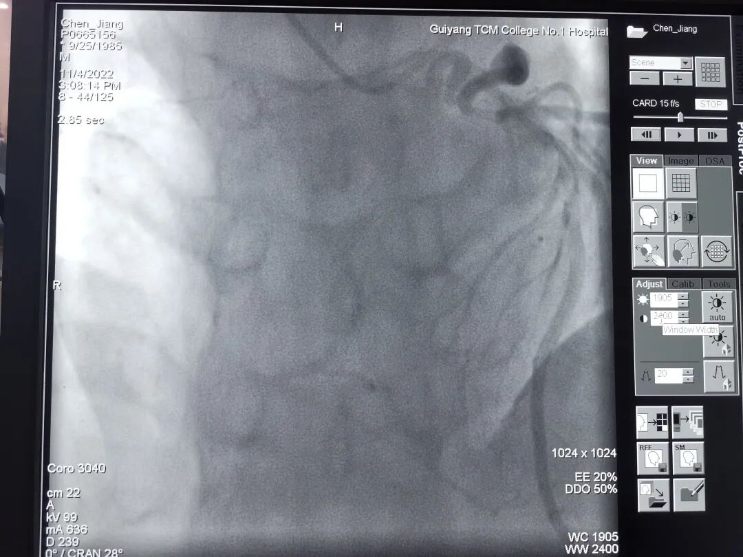 造影导丝是什么再克技术堡垒  巧破闭塞病变——心血管内科应用平行导丝技术救治冠脉慢性完全闭塞患者！_https://www.jmylbn.com_新闻资讯_第3张