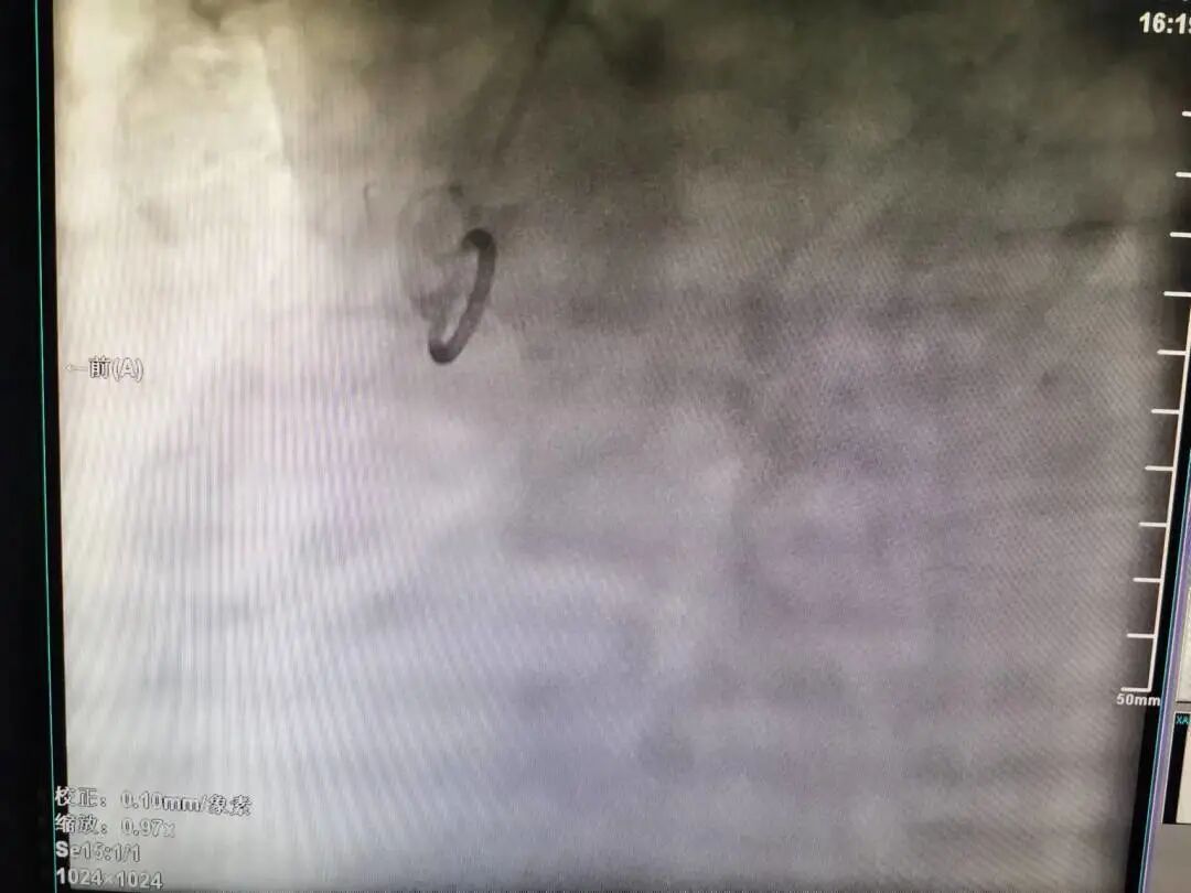 造影导丝是什么再克技术堡垒  巧破闭塞病变——心血管内科应用平行导丝技术救治冠脉慢性完全闭塞患者！_https://www.jmylbn.com_新闻资讯_第4张