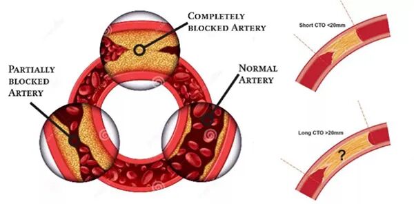 造影导丝是什么再克技术堡垒  巧破闭塞病变——心血管内科应用平行导丝技术救治冠脉慢性完全闭塞患者！_https://www.jmylbn.com_新闻资讯_第13张