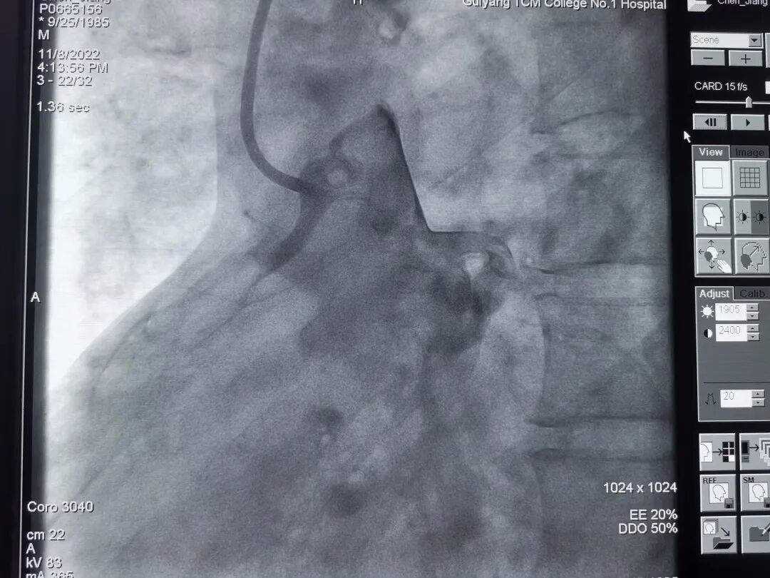 造影导丝是什么再克技术堡垒  巧破闭塞病变——心血管内科应用平行导丝技术救治冠脉慢性完全闭塞患者！_https://www.jmylbn.com_新闻资讯_第5张