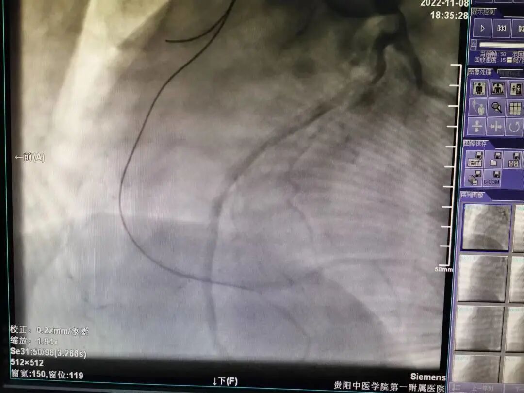 造影导丝是什么再克技术堡垒  巧破闭塞病变——心血管内科应用平行导丝技术救治冠脉慢性完全闭塞患者！_https://www.jmylbn.com_新闻资讯_第8张