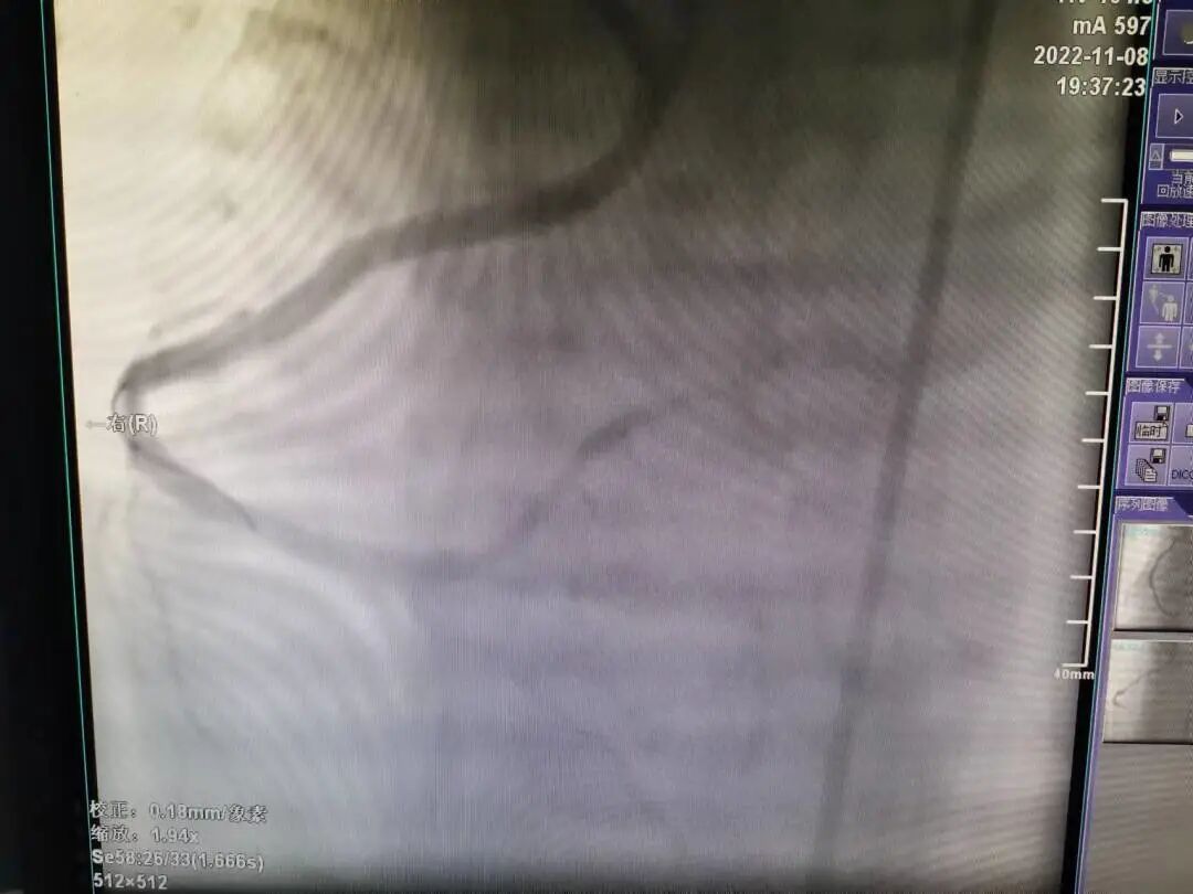 造影导丝是什么再克技术堡垒  巧破闭塞病变——心血管内科应用平行导丝技术救治冠脉慢性完全闭塞患者！_https://www.jmylbn.com_新闻资讯_第11张