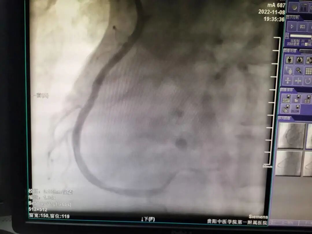 造影导丝是什么再克技术堡垒  巧破闭塞病变——心血管内科应用平行导丝技术救治冠脉慢性完全闭塞患者！_https://www.jmylbn.com_新闻资讯_第9张