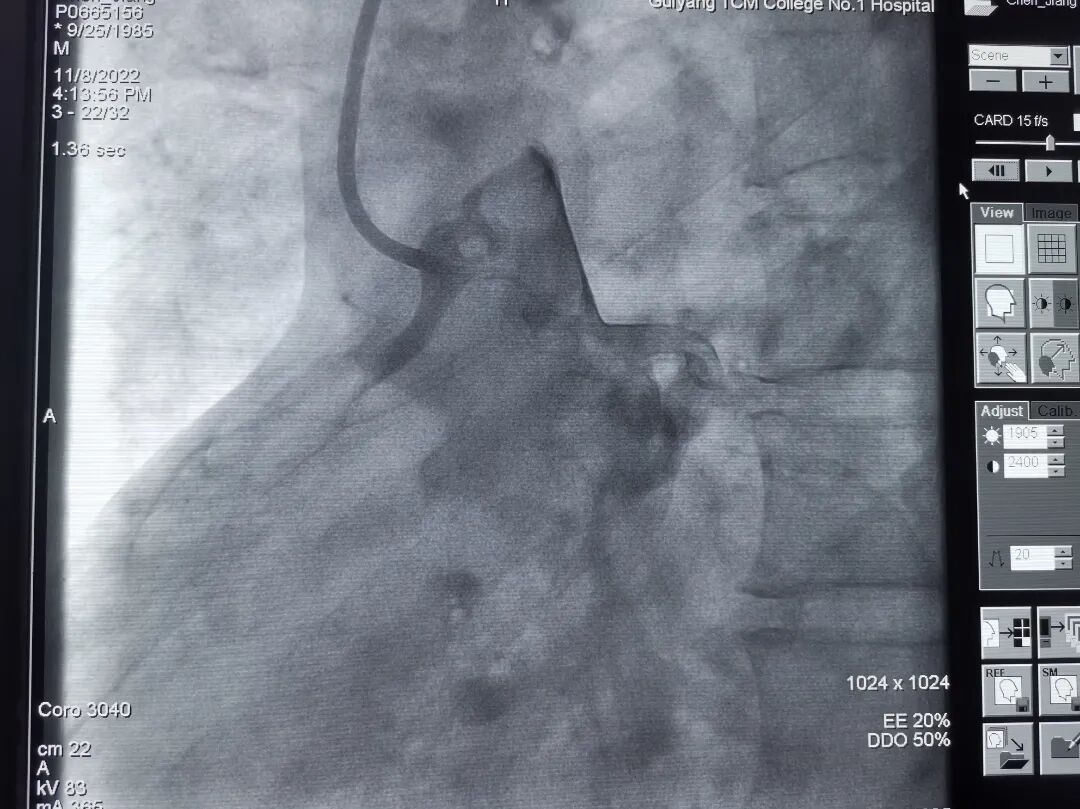 造影导丝是什么再克技术堡垒  巧破闭塞病变——心血管内科应用平行导丝技术救治冠脉慢性完全闭塞患者！_https://www.jmylbn.com_新闻资讯_第10张