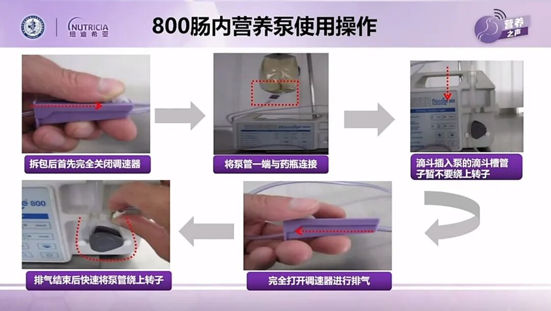 为什么用营养泵课程回放：《肠内营养泵应用技术及消化液回输护理》——孙琳教授_https://www.jmylbn.com_新闻资讯_第2张
