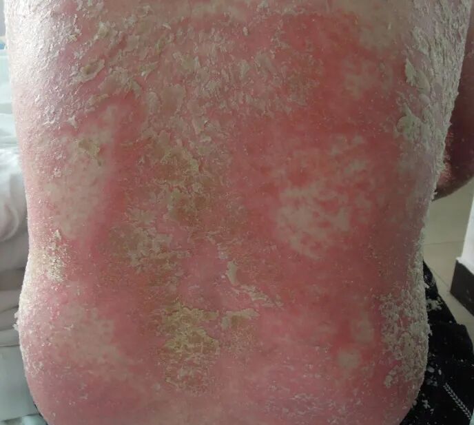 红皮型银屑病的症状表现与危害介绍,含护理方法 - 伊顿健康