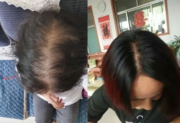 脱发吃什么药好四个方法解决女性脱发