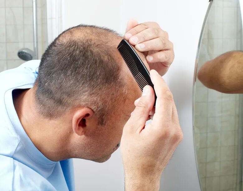 不要对头发做这5件事，小心发际线变高！2个办法拯救脱发