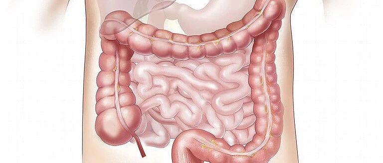 哪类结直肠息肉癌变风险最高？应该如何预防？