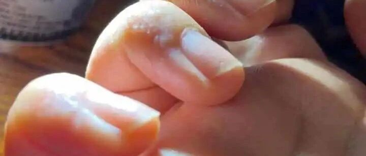 最近这个病高发！不仅灼热瘙痒，还反复发作，很多人以为和出汗有关