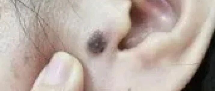 癌变的痣，这25种黑痣需警惕，转给所有人！