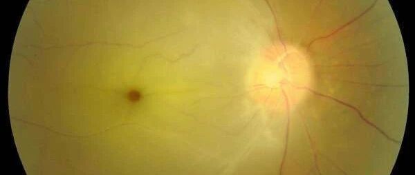 一觉醒来，31岁小伙眼睛“​瞎了”！这事太可怕，很多人却经常做​......