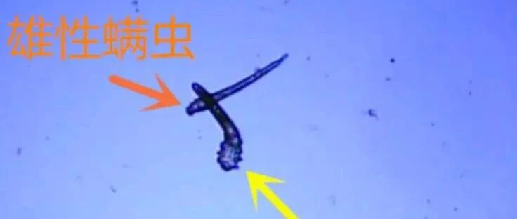 眼睛痒，三根睫毛竟揪出17条“虫”！原因是这个习惯…