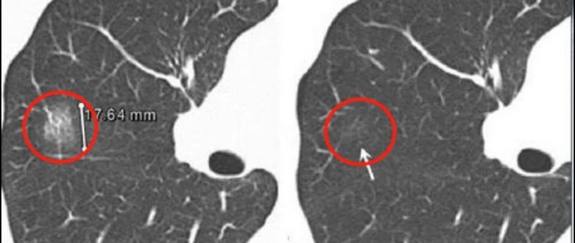一年看了上万张肺结节片子的放射科医生，告诉你：如何判断肺结节是不是肺癌？