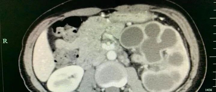 我会不会得癌了？”34岁女白领半年莫名暴瘦10斤！看医生后懊悔不已，太迟了