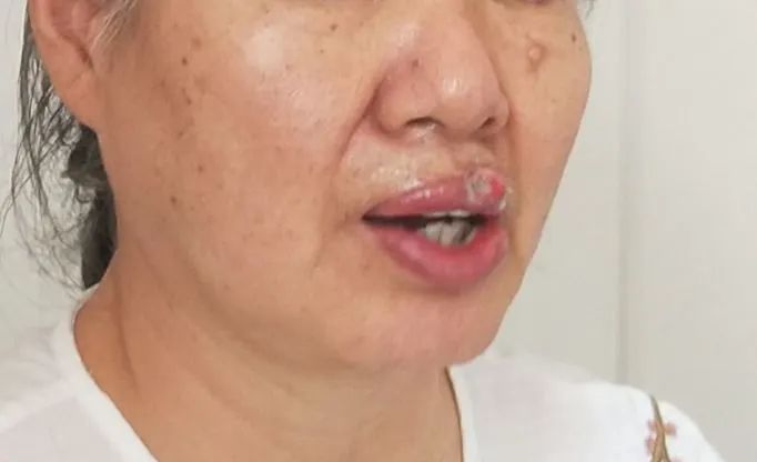 一聲慘叫，女子被自家狗咬掉上唇！ 寵物 第3張