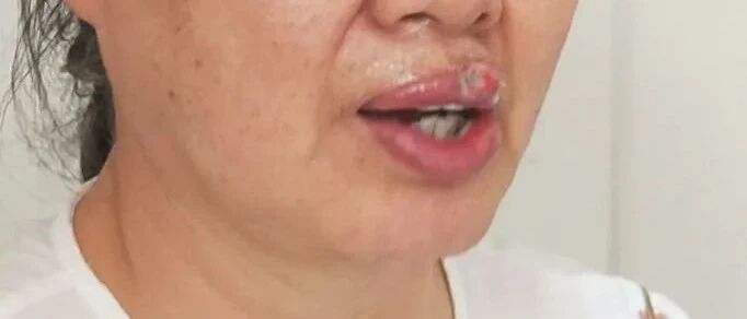 一声惨叫，女子被自家狗咬掉上唇！