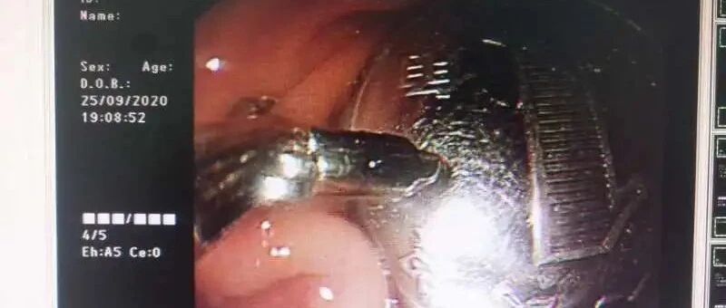 沈阳两岁男童不慎吞硬币，命悬一线……