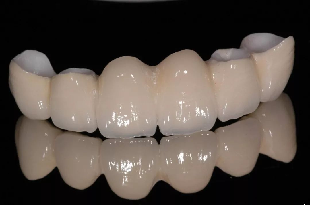 【全瓷牙】与【烤瓷牙】材料相差很大，效果也是不同！你真知道吗