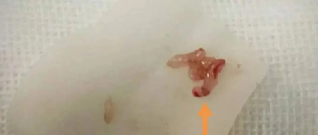 立体定向活检 丨 脑科医生看病更精准——唐山利康医院神外重症科又添新技术！