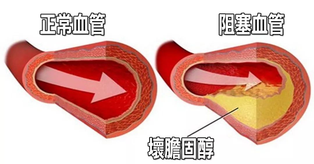 胸痛需警惕，心血管病防控從飲食開始！ 健康 第9張