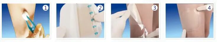 自粘伤口敷料有什么用护理大讲堂 ｜ 水胶体敷料如何促进伤口愈合？_https://www.jmylbn.com_新闻资讯_第15张